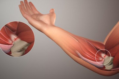 Global Soft Tissue Repair Market : Trends, Size, Growth, Opportunity, and Forecast to 2020-2027