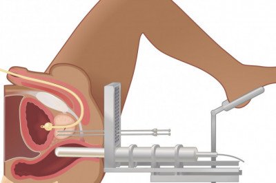 What does Happens in Brachytherapy?