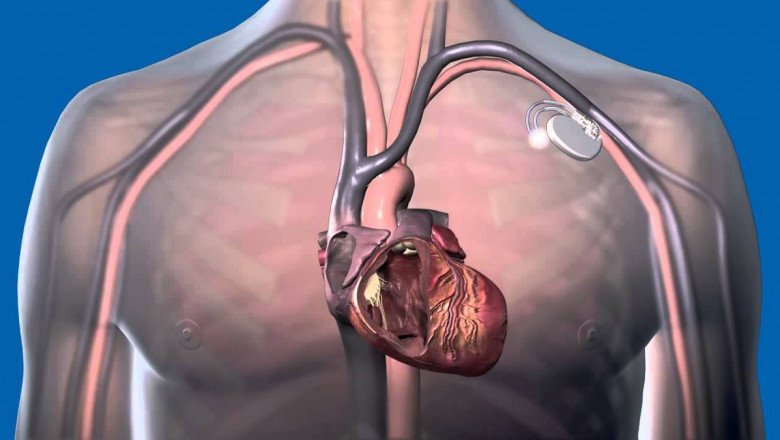 A cardiac pacemaker is used to treat a variety of heart-related conditions, such as bradycardia, atrial fibrillation, and slow heartbeats