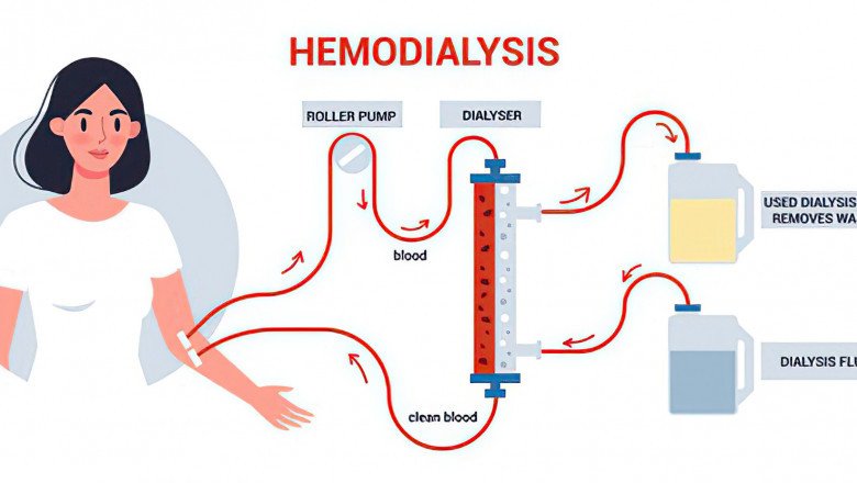 Hemodialysis and Peritoneal Dialysis Market: Global Industry Trends, Share, Size, Growth, Opportunity and Forecast 2022-2028