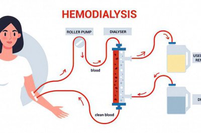 Hemodialysis and Peritoneal Dialysis Market: Global Industry Trends, Share, Size, Growth, Opportunity and Forecast 2022-2028