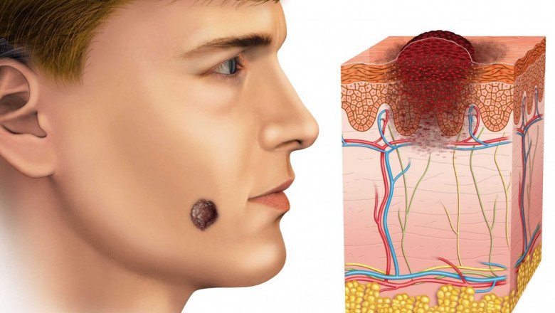 Kaposi Sarcoma Treatment Market: Global Industry Trends, Share, Size, Growth, Opportunity and Forecast 2022-2028