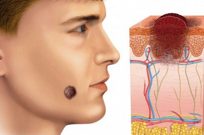 Kaposi Sarcoma Treatment Market: Global Industry Trends, Share, Size, Growth, Opportunity and Forecast 2022-2028