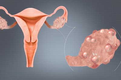 How to Cure Your PCOS
