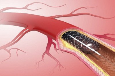 Coronary Stents are expandable metal meshes that have improved percutaneous coronary revascularization outcomes