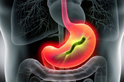 During The Past Few Years, The Gastric Cancer Therapeutics Has Improved Significantly, And New Advances Are Being Made Every Day