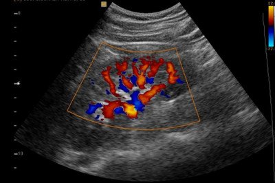 A Doppler Ultrasound Can Be Used To Assess Blood Flow In An Area