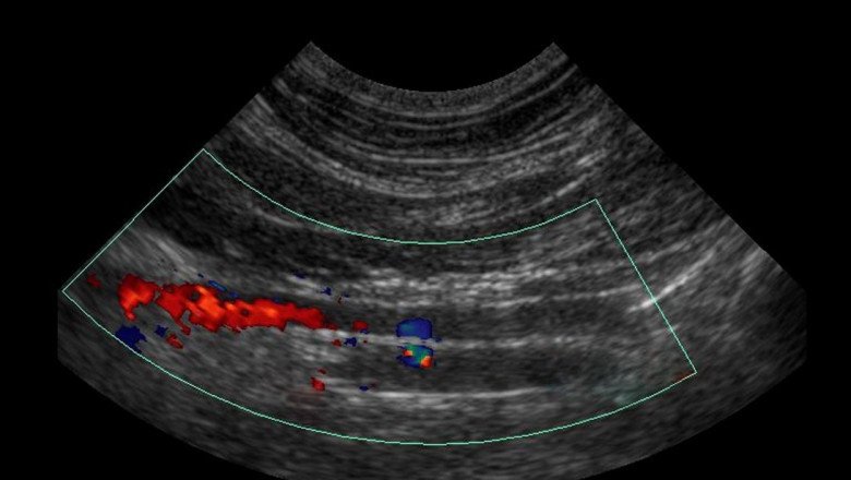 Ultrasound Can Be Used To Estimate Blood Flow Through Blood Vessels Through Doppler Ultrasound
