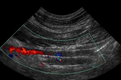 Ultrasound Can Be Used To Estimate Blood Flow Through Blood Vessels Through Doppler Ultrasound