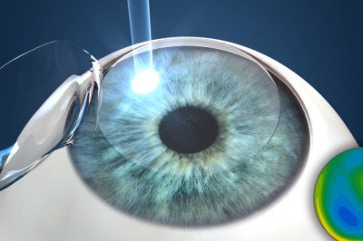 Custom LASIK Surgery Market will be driven by increasing prevalence of ophthalmic disorders and technological developments in custom LASIK procedures