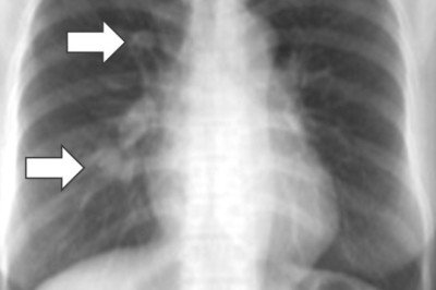 There Is No Place Where A Desmoid Tumors Can't Occur As Your Body Is Made Up Of Connective Tissue