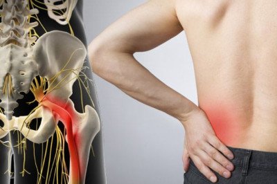 Lower Back Pain Radiates To The Buttock, Then Down To The Leg With Sciatica