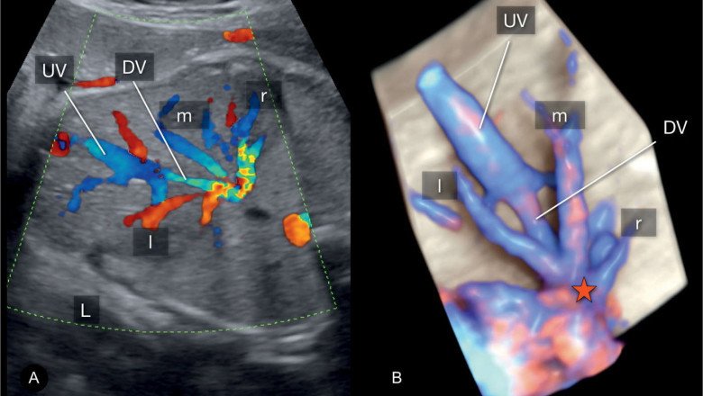 The Doppler Ultrasound That Uses Doppler Technology Is Used To Determine Blood Flow In The Body