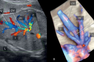 The Doppler Ultrasound That Uses Doppler Technology Is Used To Determine Blood Flow In The Body