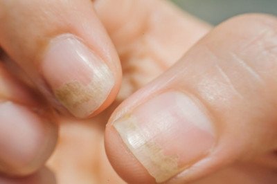 Onychomycosis Treatment Market Global Industry Trends, Share, Size, Growth, Opportunity and Forecast 2022-2028