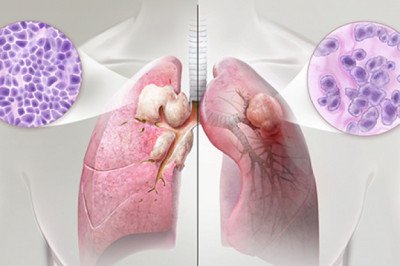 Non-Small Cell Lung Cancer Market Modern Trends, Top Regions and Latest Entries Forecast 2030