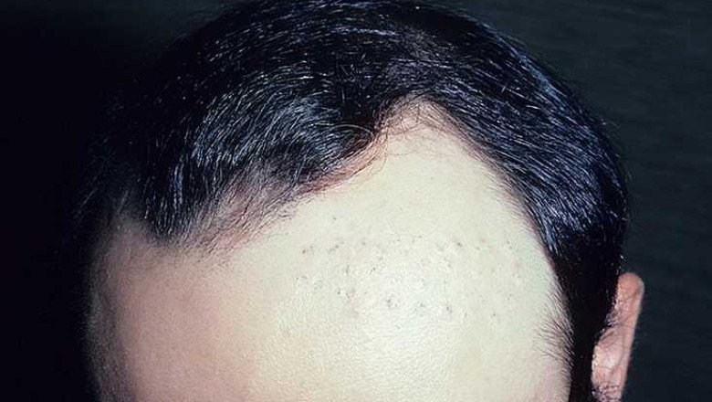 Comparing Different Types of Medications in Androgenetic Alopecia Treatment Market