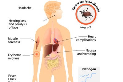 Lyme Disease Treatment Market Overview Analysis, Growth Factor and Forecast to 2028
